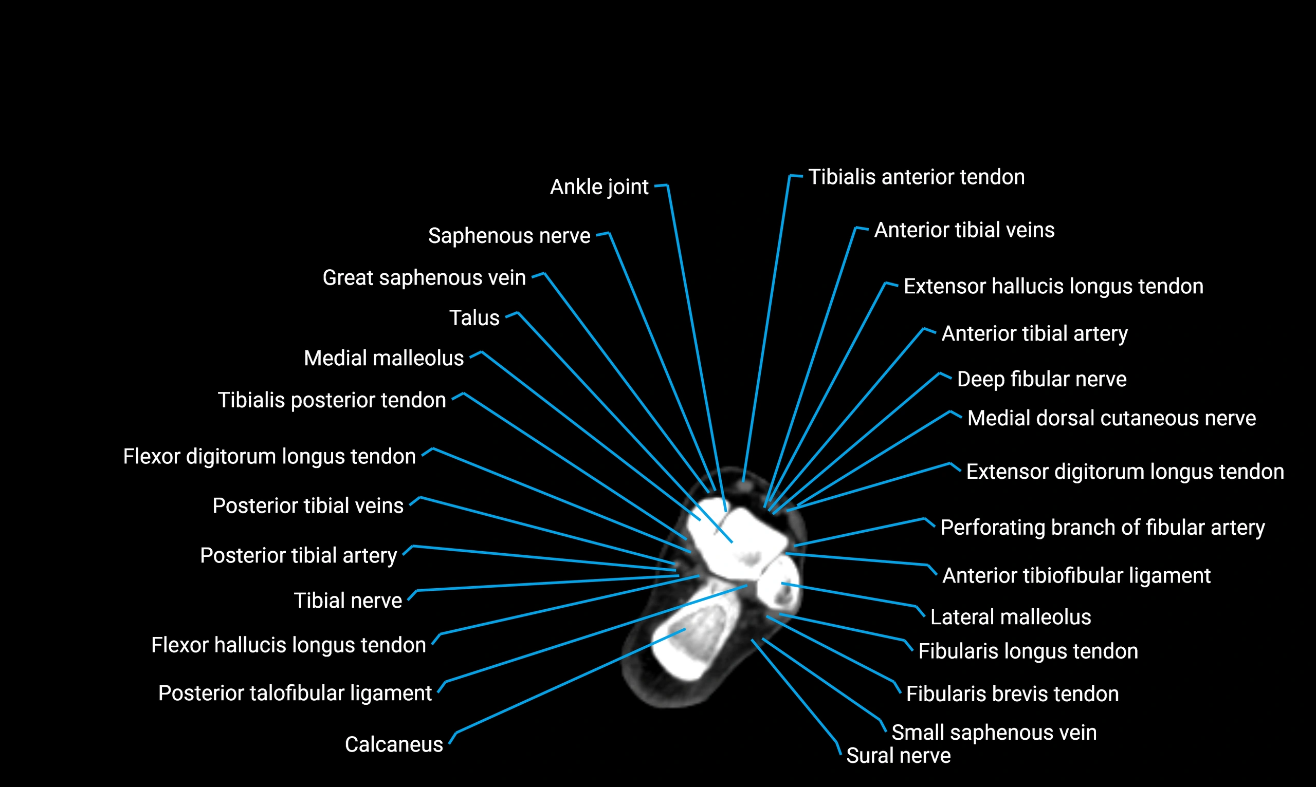 CT lower limb axial cross sectional anatomy labelled image 167 (2).webp